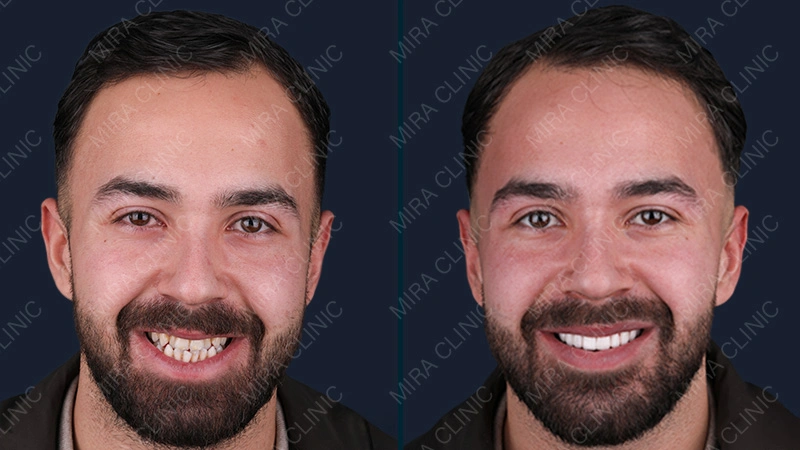 Before and After Hollywood smile 